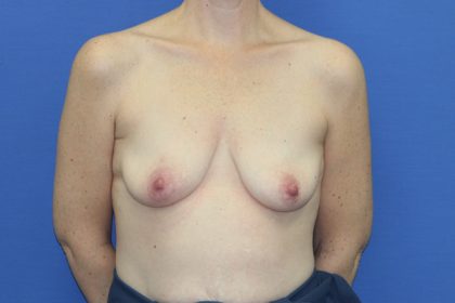 Breast Augmentation with Lift Before & After Patient #3055