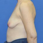 Breast Augmentation with Lift Before & After Patient #3055