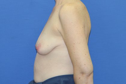Breast Augmentation with Lift Before & After Patient #3055
