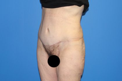 Tummy Tuck Before & After Patient #3408