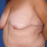 Breast Lift Before & After Patient #3470