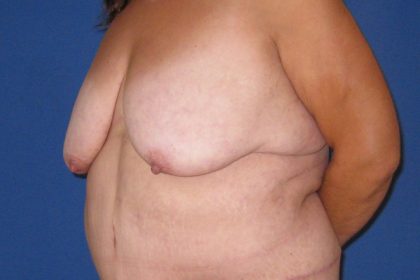 Breast Lift Before & After Patient #3470