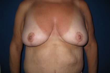 Breast Lift Before & After Patient #3470