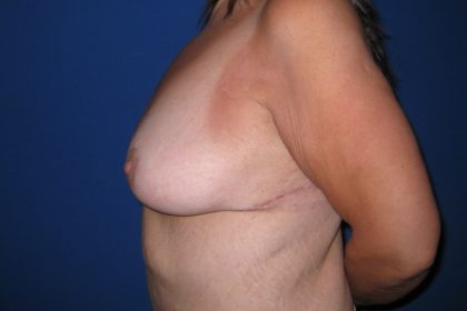 Breast Lift Before & After Patient #3470