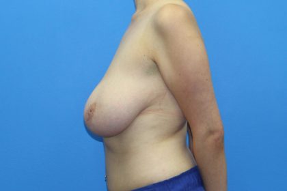 Breast Reduction Before & After Patient #2836