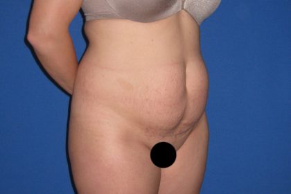 Tummy Tuck Before & After Patient #3331