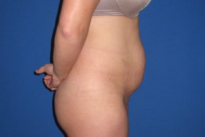 Tummy Tuck Before & After Patient #3331