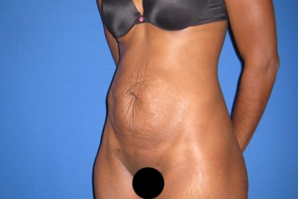 Tummy Tuck Before & After Patient #3359