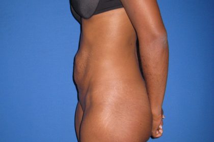 Tummy Tuck Before & After Patient #3359