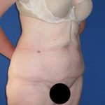 Tummy Tuck Before & After Patient #3352