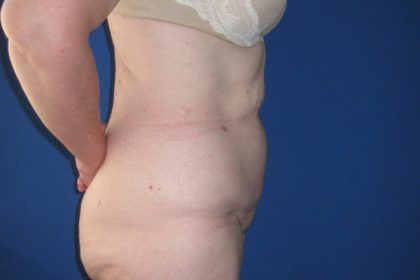 Tummy Tuck Before & After Patient #3352