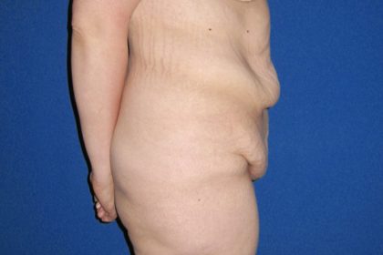 Tummy Tuck Before & After Patient #3246