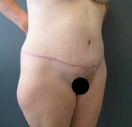 Tummy Tuck Before & After Patient #3394