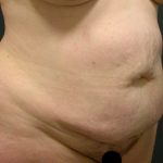 Tummy Tuck Before & After Patient #3394