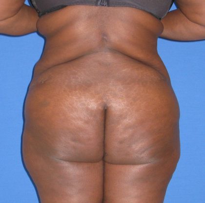 Liposuction Before & After Patient #3697