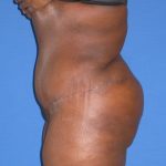 Liposuction Before & After Patient #3697