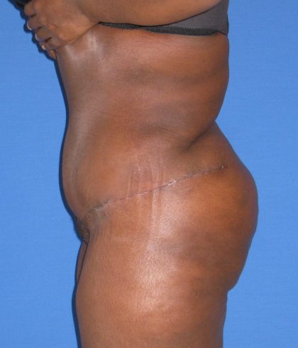 Liposuction Before & After Patient #3697