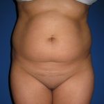 Liposuction Before & After Patient #3702