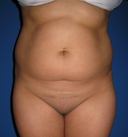 Liposuction Before & After Patient #3702