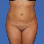 Liposuction Before & After Patient #3702