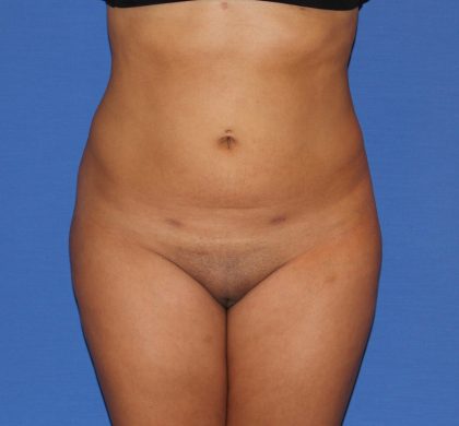 Liposuction Before & After Patient #3702