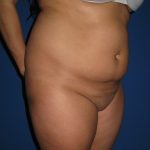 Liposuction Before & After Patient #3702