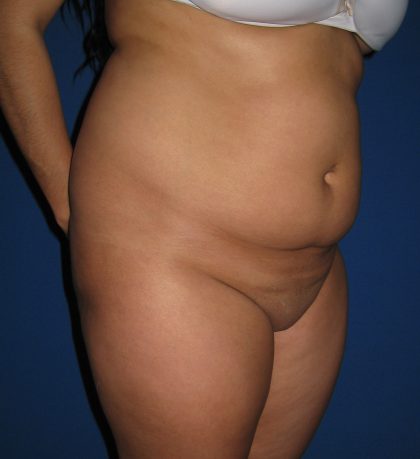 Liposuction Before & After Patient #3702