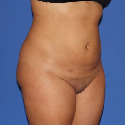 Liposuction Before & After Patient #3702