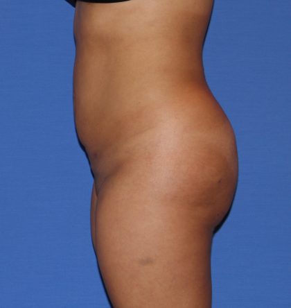 Liposuction Before & After Patient #3702