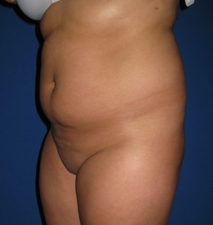 Liposuction Before & After Patient #3702