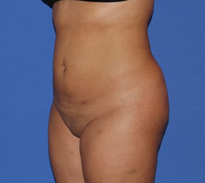 Liposuction Before & After Patient #3702