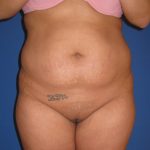 Liposuction Before & After Patient #3711