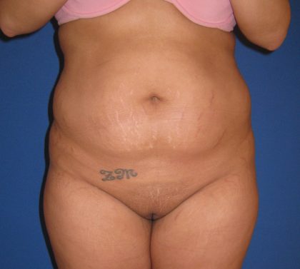 Liposuction Before & After Patient #3711