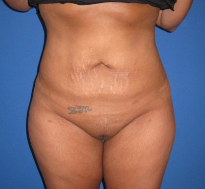 Liposuction Before & After Patient #3711