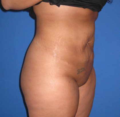 Liposuction Before & After Patient #3711