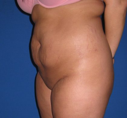 Liposuction Before & After Patient #3711