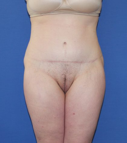 Lower Body Lift Before & After Patient #3724