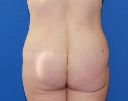 Lower Body Lift Before & After Patient #3724