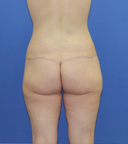 Lower Body Lift Before & After Patient #3768