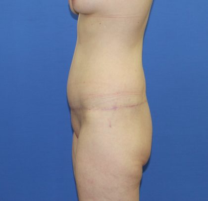 Lower Body Lift Before & After Patient #3768
