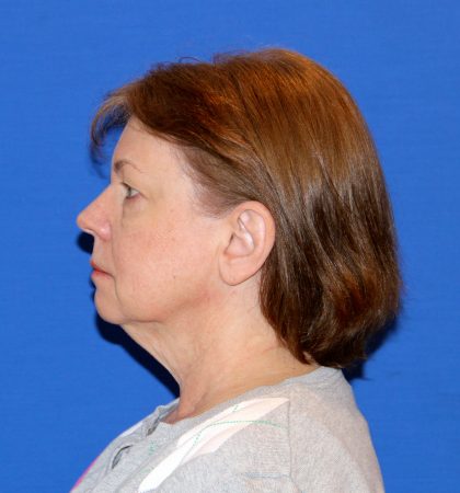 Facelift Before & After Patient #2847