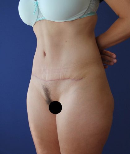 Tummy Tuck Before & After Patient #3185