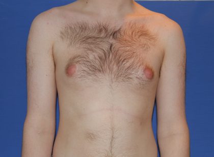 Gynecomastia Before & After Patient #2885