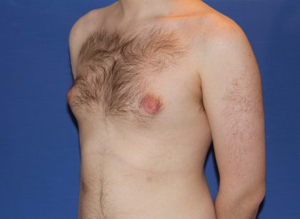 Gynecomastia Before & After Patient #2885