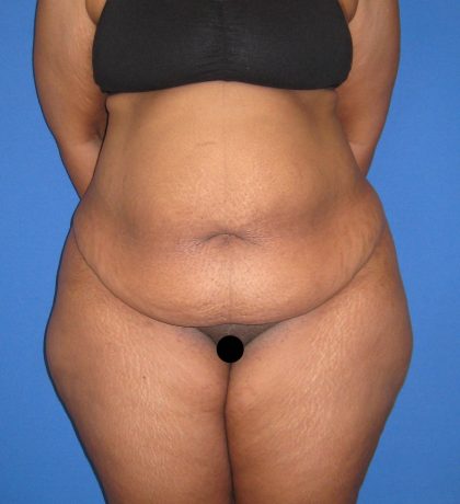 Tummy Tuck Before & After Patient #3213