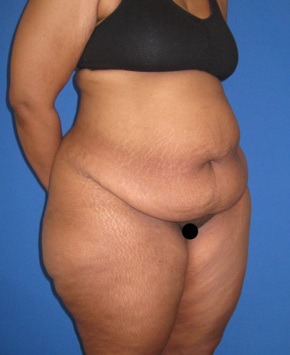 Tummy Tuck Before & After Patient #3213
