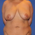 Breast Reduction Before & After Patient #2818