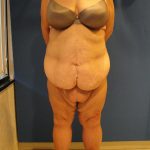 Panniculectomy Before & After Patient #3577