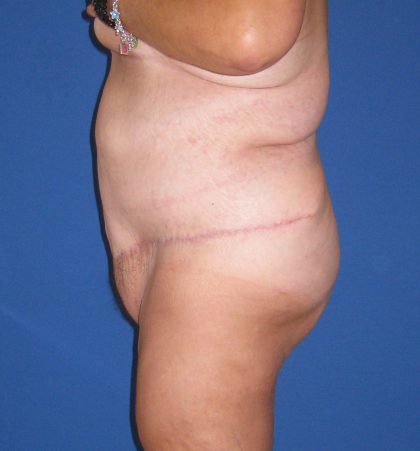 Panniculectomy Before & After Patient #3577