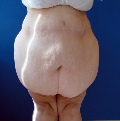 Panniculectomy Before & After Patient #3582